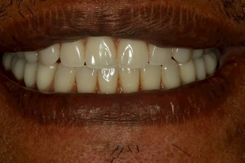 รอยยิ้มของคนไข้หลังใส่ฟันปลอมทั้งปาก ถ่ายโดยไม่ใส่ที่ถ่างปาก — ครอปเฉพาะบริเวณปาก ไม่เห็นใบหน้า