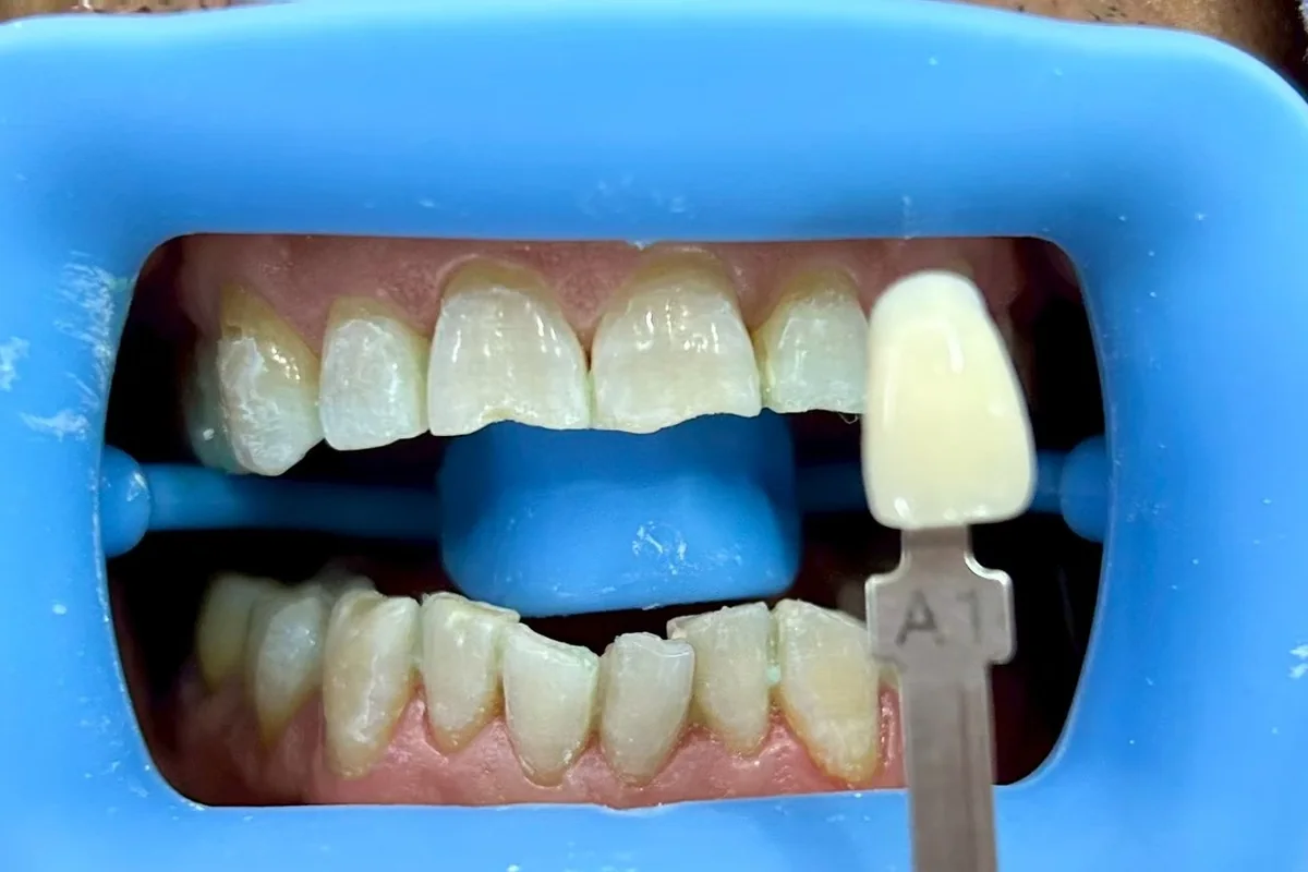 ฟันหน้าหลังฟอกสีฟัน มีแถบเทียบสีทาบอยู่ข้างฟัน อ่านได้ที่เฉด A1 ครอปเฉพาะบริเวณช่องปาก