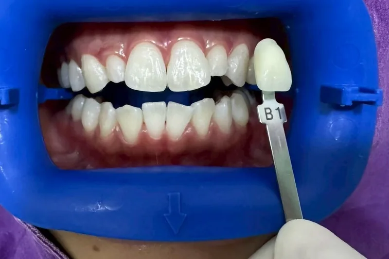 ฟันหน้าหลังฟอกสีฟัน มีแถบเทียบสีทาบอยู่ข้างฟัน อ่านได้ที่เฉด B1 ครอปเฉพาะบริเวณช่องปาก