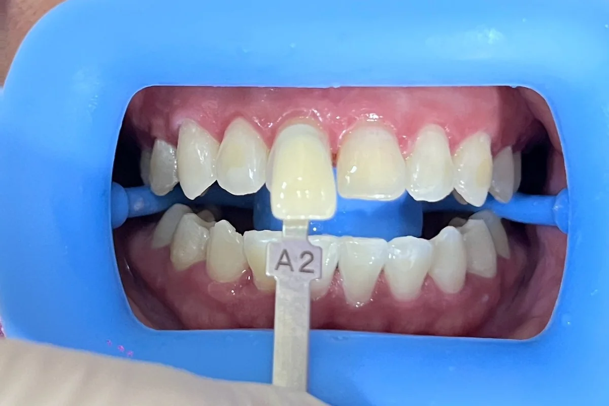 ฟันหน้าหลังฟอกสีฟัน มีแถบเทียบสีทาบอยู่ข้างฟัน อ่านได้ที่เฉด A2 ครอปเฉพาะบริเวณช่องปาก