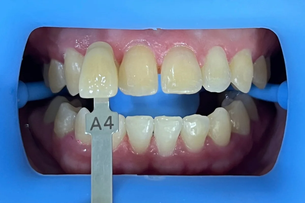 ฟันหน้าก่อนฟอกสีฟัน มีแถบเทียบสีทาบอยู่ข้างฟัน อ่านได้ที่เฉด A4 ครอปเฉพาะบริเวณช่องปาก