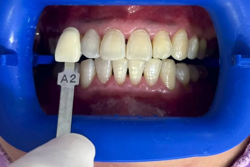 ฟันหน้าหลังฟอกสีฟัน มีแถบเทียบสีทาบอยู่ข้างฟัน อ่านได้ที่เฉด A2 ครอปเฉพาะบริเวณช่องปาก