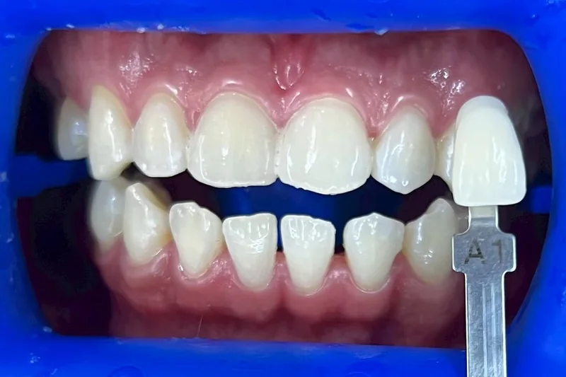 ฟันหน้าหลังฟอกสีฟัน มีแถบเทียบสีทาบอยู่ข้างฟัน อ่านได้ที่เฉด A1 ครอปเฉพาะบริเวณช่องปาก