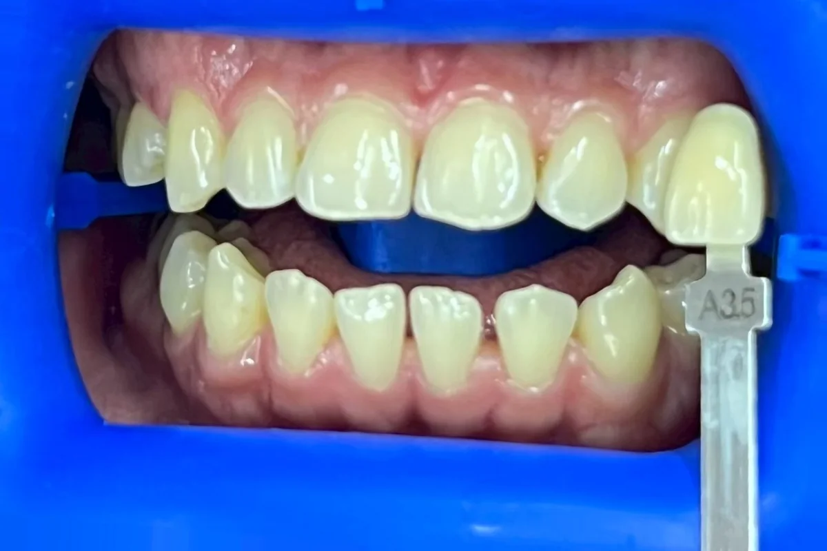 ฟันหน้าก่อนฟอกสีฟัน มีแถบเทียบสีทาบอยู่ข้างฟัน อ่านได้ที่เฉด A3.5 ครอปเฉพาะบริเวณช่องปาก