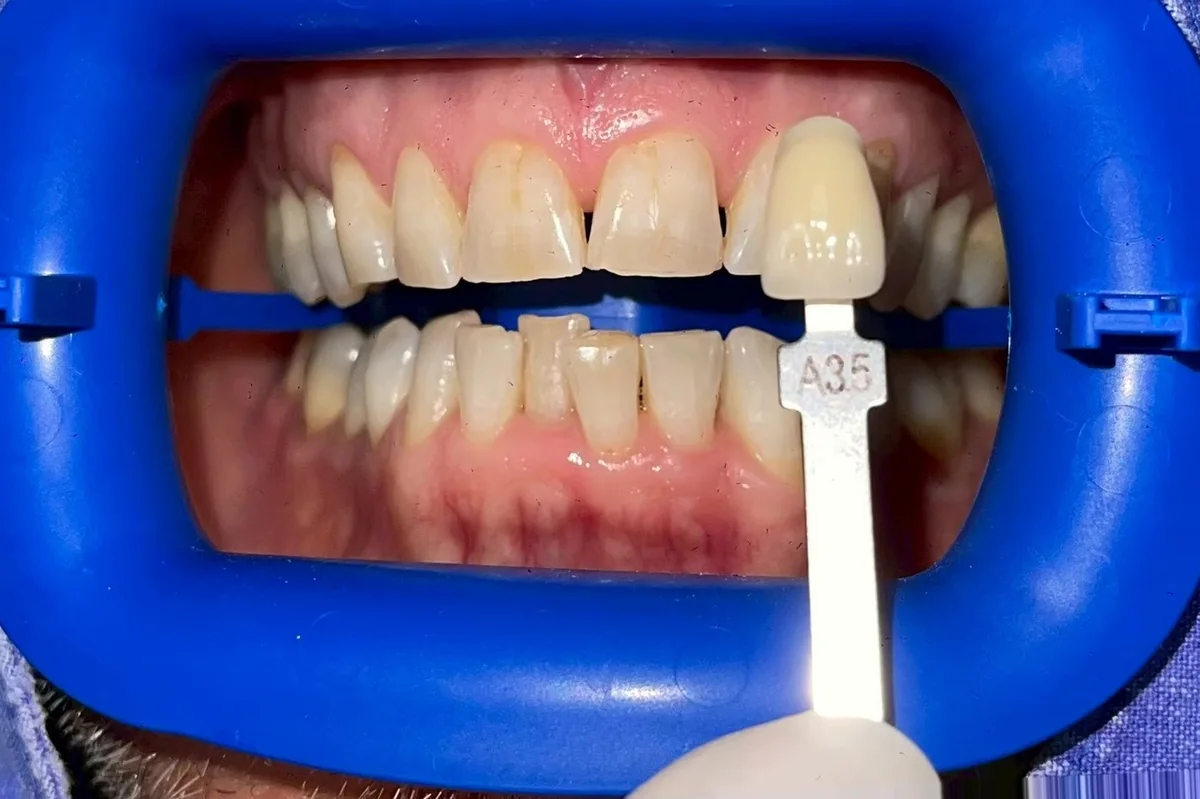 ฟันหน้าก่อนฟอกสีฟัน มีแถบเทียบสีทาบอยู่ข้างฟัน อ่านได้ที่เฉด A3.5 ครอปเฉพาะบริเวณช่องปาก