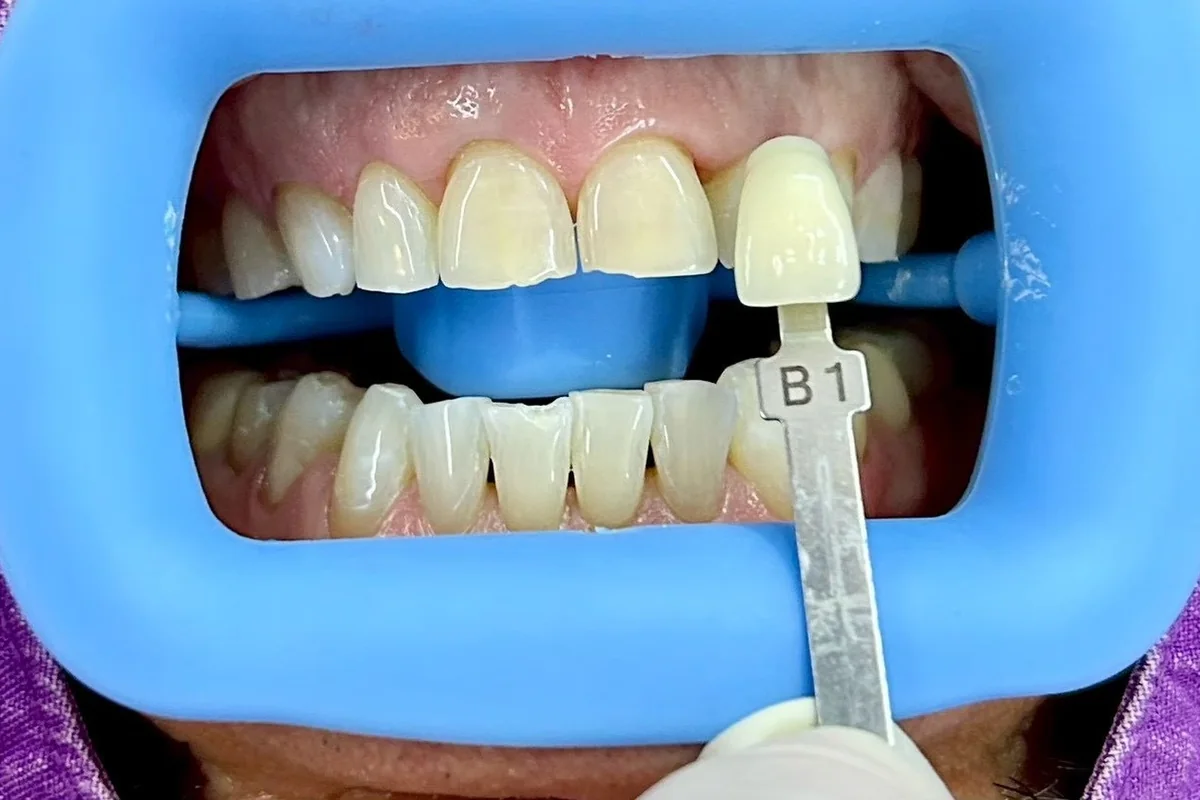 ฟันหน้าหลังฟอกสีฟัน มีแถบเทียบสีทาบอยู่ข้างฟัน อ่านได้ที่เฉด B1 ครอปเฉพาะบริเวณช่องปาก