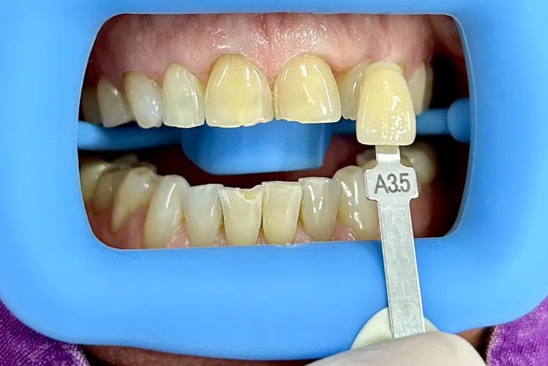 ฟันหน้าก่อนฟอกสีฟัน มีแถบเทียบสีทาบอยู่ข้างฟัน อ่านได้ที่เฉด A3.5 ครอปเฉพาะบริเวณช่องปาก
