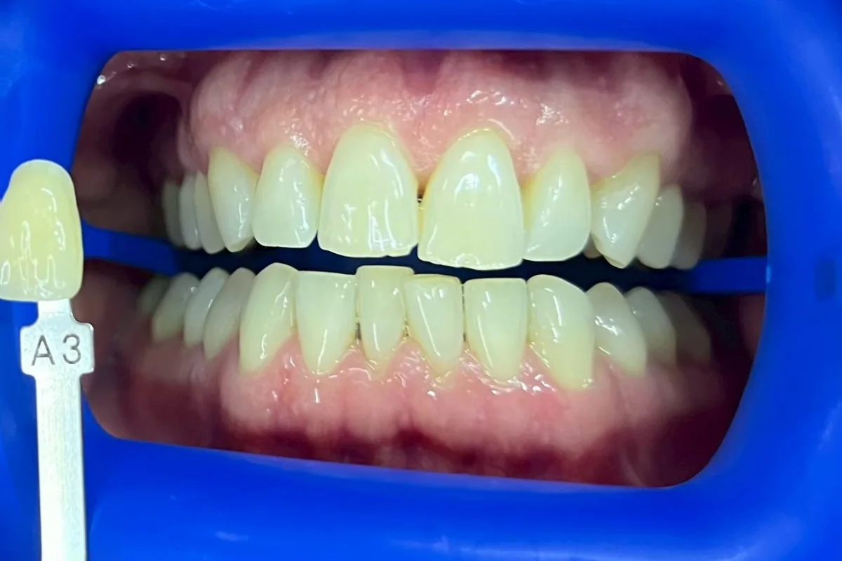 ฟันหน้าก่อนฟอกสีฟัน มีแถบเทียบสีทาบอยู่ข้างฟัน อ่านได้ที่เฉด A3 ครอปเฉพาะบริเวณช่องปาก
