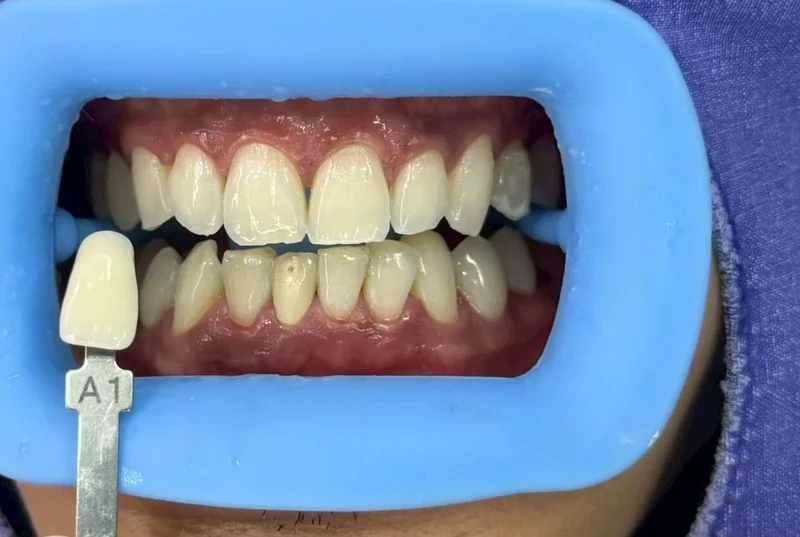ฟันหน้าหลังฟอกสีฟัน มีแถบเทียบสีทาบอยู่ข้างฟัน อ่านได้ที่เฉด A1 ครอปเฉพาะบริเวณช่องปาก