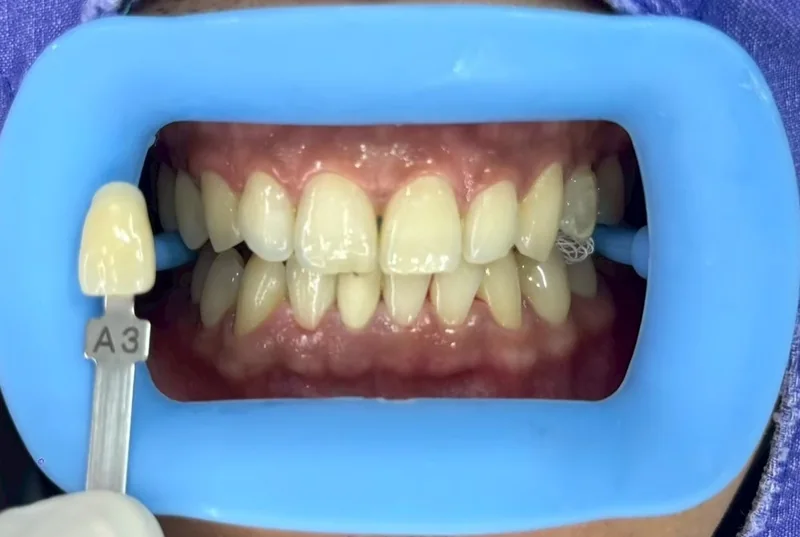 ฟันหน้าก่อนฟอกสีฟัน มีแถบเทียบสีทาบอยู่ข้างฟัน อ่านได้ที่เฉด A3 ครอปเฉพาะบริเวณช่องปาก