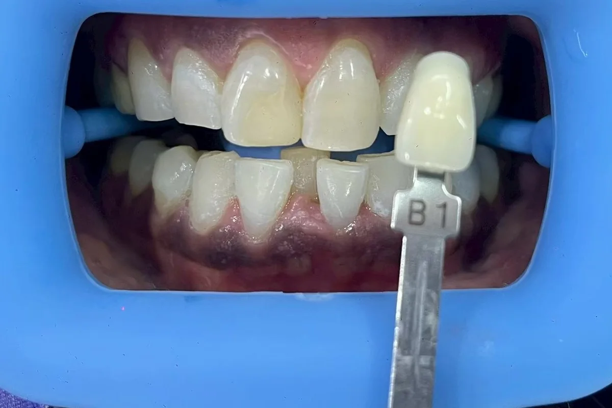 ฟันหน้าหลังฟอกสีฟัน มีแถบเทียบสีทาบอยู่ข้างฟัน อ่านได้ที่เฉด B1 ครอปเฉพาะบริเวณช่องปาก