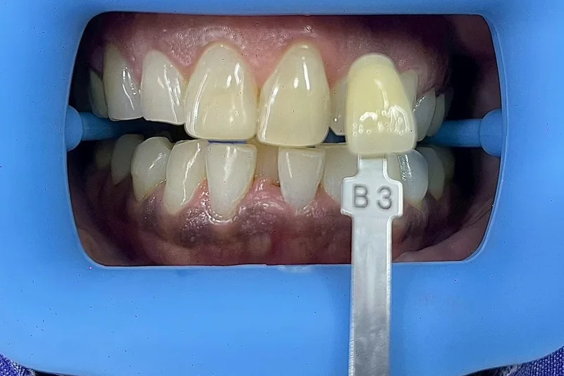 ฟันหน้าก่อนฟอกสีฟัน มีแถบเทียบสีทาบอยู่ข้างฟัน อ่านได้ที่เฉด B3 ครอปเฉพาะบริเวณช่องปาก