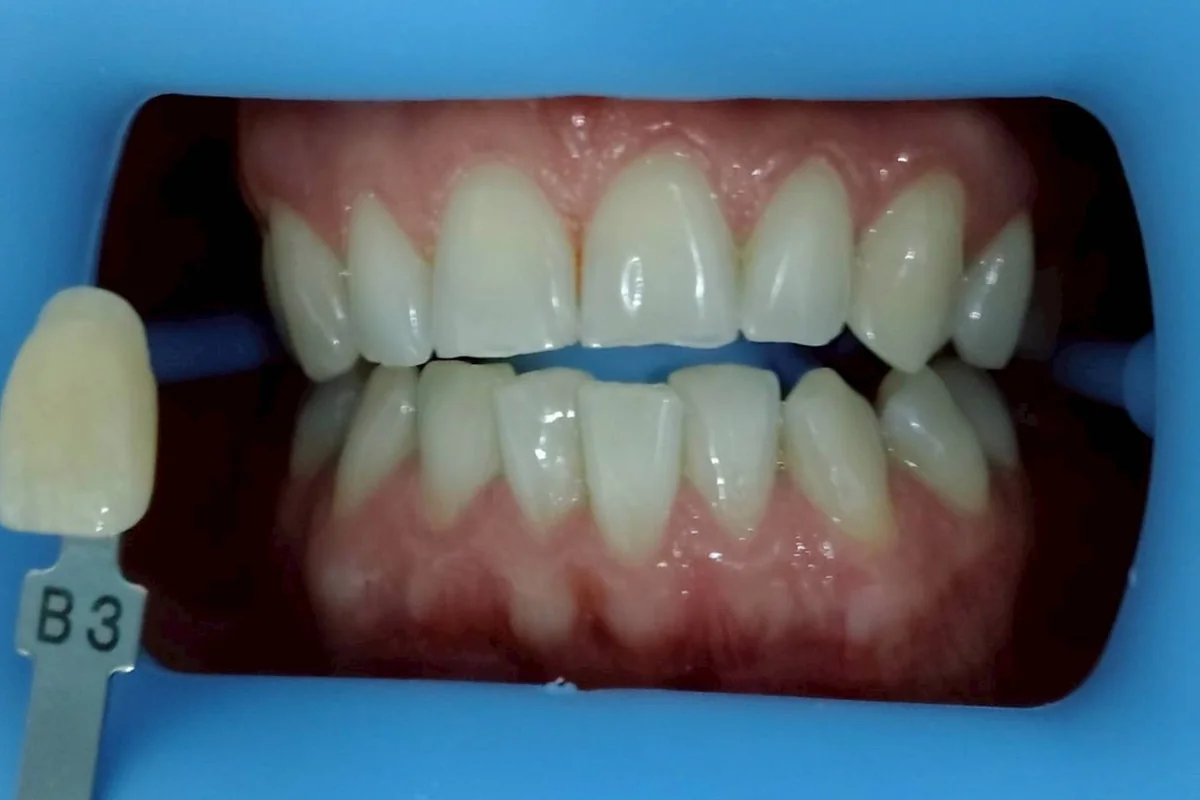 ฟันหน้าก่อนฟอกสีฟัน มีแถบเทียบสีทาบอยู่ข้างฟัน อ่านได้ที่เฉด B3 ครอปเฉพาะบริเวณช่องปาก