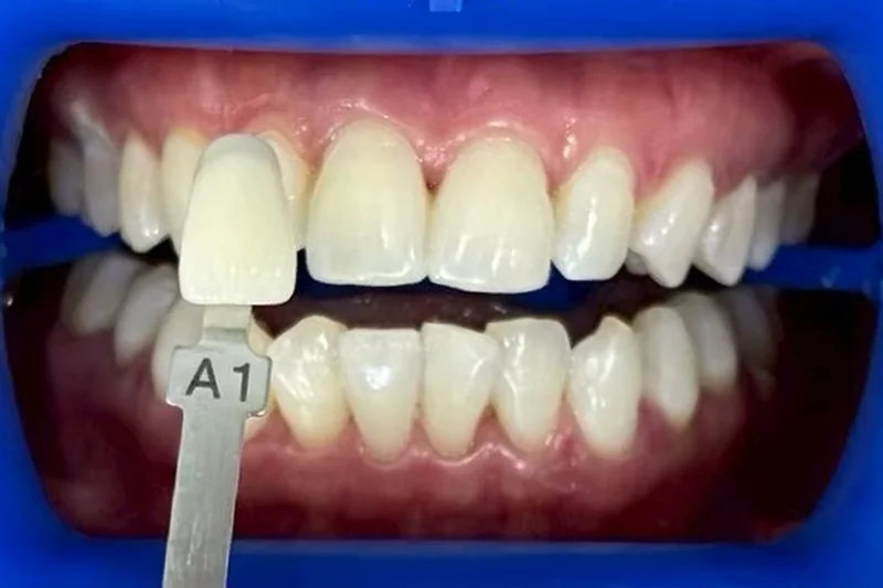 ฟันหน้าหลังฟอกสีฟัน มีแถบเทียบสีทาบอยู่ข้างฟัน อ่านได้ที่เฉด A1 ครอปเฉพาะบริเวณช่องปาก
