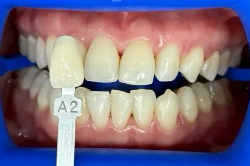 ฟันหน้าก่อนฟอกสีฟัน มีแถบเทียบสีทาบอยู่ข้างฟัน อ่านได้ที่เฉด A2 ครอปเฉพาะบริเวณช่องปาก